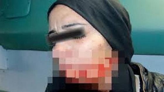 سيدة تُعرِّض وجهها للتشويه بجروح قطعية بليغة بواسطة سكين وترفض علاجها لهذا “السبب” بالناظور
