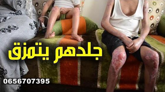 شوفو هاد الطفل وختو كيف كيتمزق الجلد دياهم