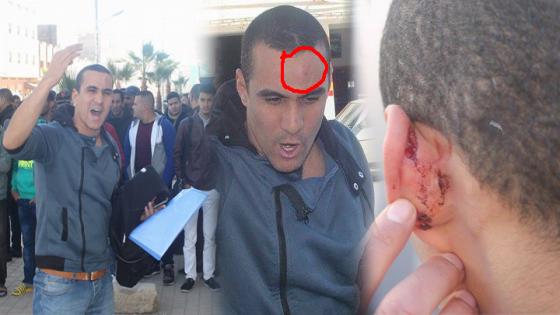 بعد تعرضه لإعتداء من طرف عضو بجمعية أنوال .. صور تظهر أثار الضرب والدماء على وجه الطالب إبراهيم بوخزو