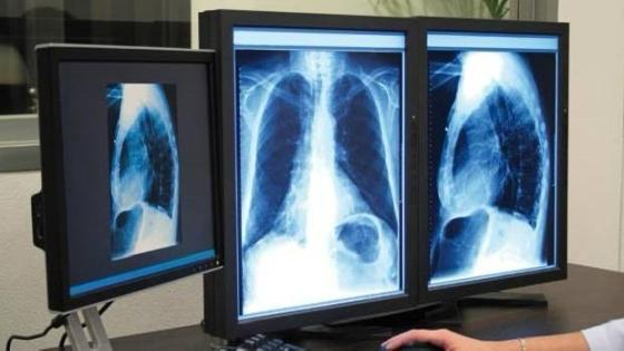 انتشار البكتيريا المسببة لداء السل بالناظور تلزم حقوقيون لدق ناقوس الخطر