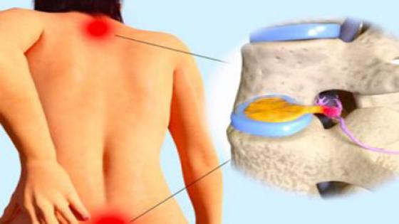 تعرف على كيفية علاج تشنجات الظهر المؤلمة